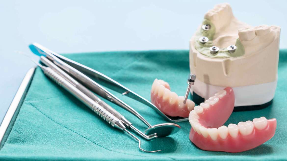 El implante dental