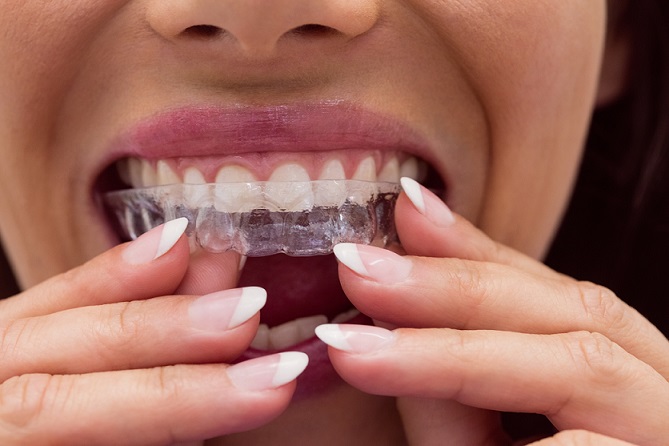 Ortodoncia correctiva: qué es y tipos