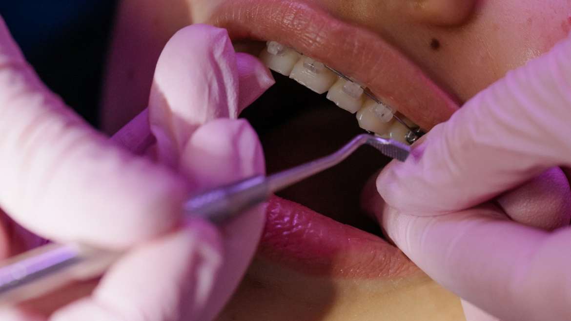 Tres consejos para cuidar tu ortodoncia